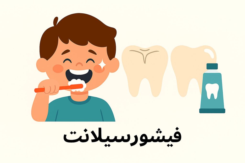 فیشورسیلانت