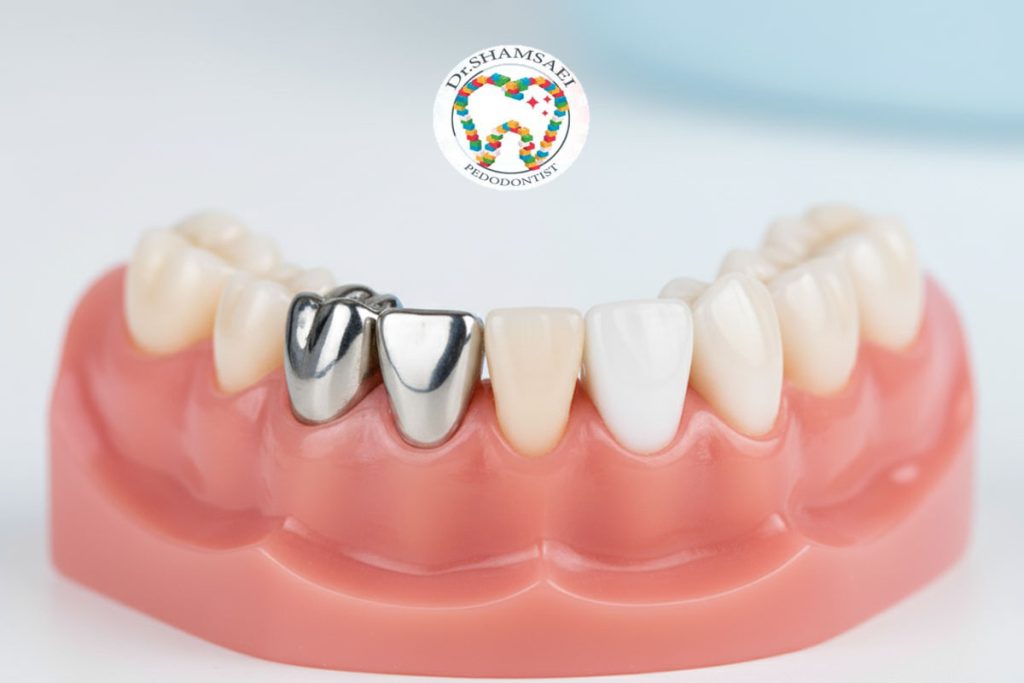 روکش فلزی یا سفید؟